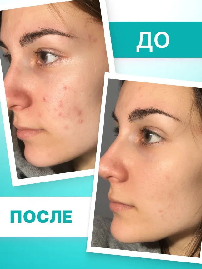Крем локального действия для проблемной кожи TeenSkin